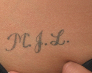 tattoo removal before Dover new jersey